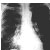 thumbnail image of  Pneumocystis jiroveci
                    (formerly
                    carinii
                    ) pneumonia: unilateral alveolar infiltrate
                